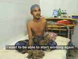 Tree Man Who Got Cured Of His Rare Condition!