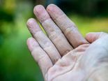 Is Your Skin Getting Too Dry? These Medical Conditions Could Be The Reason, Check It