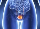 Symptoms Of Bladder Cancer Every Woman Should Know