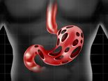 Top Common Causes Of Peptic Ulcer Disease