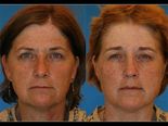 Can Identical Twins Look This Different Due To Smoking? 