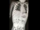 Needles Were Found Inside A Girl’s Body After Horrific 'Black Magic' Abuse 