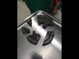 Bizarre Case Of A Man Getting His Pen*s Stuck In A Dumbbell