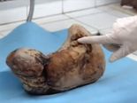 Doctors Forced Her To Deliver Her Unborn Child After 46 Years!