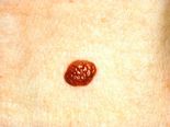 The Complete Guide to Melanoma: Symptoms, Causes, and Cure