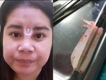 Her Silicon Implant Was Left Poking Through Her Skin