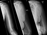Woman's Bones Vanish Before Doctors' Eyes