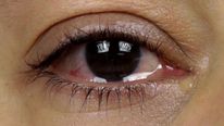 OMG! 14 Worms Were Removed From This Woman’s Left Eye!