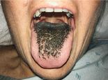 Can You Believe Her Tongue Turned Hairy Due To Medication!