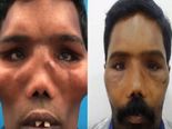 ‘Lion-faced’ Man's Transformation After Life-changing Surgery