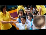 Toddler Loses Hair Due To Stress