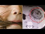 8-Year-Old Girl Has A 3-Pound Hairball In Stomach!