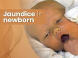 Jaundice In Newborns: Causes, Symptoms, Risk Factors, Diagnosis And Treatment 