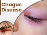 Chagas Disease: Causes, Symptoms, Risk Factors, Treatment And Prevention