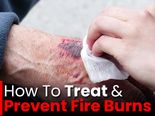 Fire Burns: Treatment And Prevention Tips
