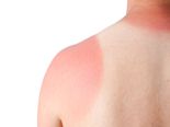 11 Amazing Natural Remedies For Sunburn