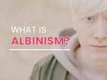 International Albinism Awareness Day 2021: What Is Albinism? Causes, Symptoms And Treatments