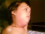பொன்னுக்கு வீங்கி வருவதற்கான காரணங்கள், அறிகுறிகள் மற்றும் சிகிச்சைகள்!
