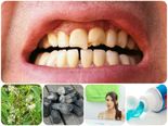 சொத்தைப் பற்களை இயற்கை வழியில் சரிசெய்ய சில டிப்ஸ்...