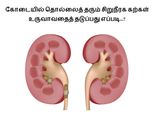 கோடையில் தொல்லைத் தரும் சிறுநீரக கற்கள் உருவாவதைத் தடுப்பது எப்படி...?