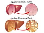 அமைதியாக இருந்து ஆளைக் கொல்லும் கல்லீரல் கொழுப்புக்களை சரிசெய்யும் கிராமத்து கை வைத்தியங்கள்!