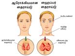 ஹைப்பர் தைராய்டு பிரச்சனையைக் கட்டுப்படுத்த சில எளிய இயற்கை வழிகள்!