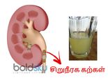 சிறுநீரக கற்களை கரைக்க இந்த ஜூஸை தினமும் அரை டம்ளர் குடித்தால் போதும்!