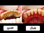 பற்களின் பின் இருக்கும் அசிங்கமான மஞ்சள் கறைகளைப் போக்கும் எளிய வழிகள்!