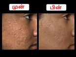 முகத்தில் அசிங்கமா மேடு பள்ளங்கள் உள்ளதா? அதை மறைக்க இதோ சில அற்புத வழிகள்!