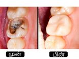 சொத்தைப் பல்லை இயற்கை வழியில் போக்குவது எப்படி?