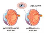 சர்க்கரை நோயும், கண் பார்வையும்: தெரிந்துக் கொள்ள வேண்டியவை, செய்ய கூடாதவை!