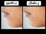 ஒரே வாரத்தில் சருமத்தில் இருக்கும் அசிங்கமான தழும்புகளைப் போக்க வேண்டுமா? அப்ப இத ட்ரை பண்ணுங்க...