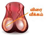 விதை பெரிதாவது எதனால்? இதற்கான காரணம் என்ன? எப்படி சரி செய்வது? 