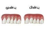 ஈறுகள் மேலே ஏறி அசிங்கமாக உள்ளதா? அதை சரிசெய்ய இதோ சில எளிய வழிகள்!