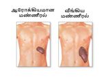 மண்ணீரல் வீக்கத்திற்கான அறிகுறியும்.. அதை சரிசெய்ய உதவும் சில இயற்கை வழிகளும்...