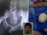14 வயது சிறுவன் முட்டையிடும் அதிசயம்!  