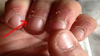 உங்க கை விரலில் இப்படி தோல் உரியுதா? அப்ப உடம்புல இந்த சத்து கம்மியா இருக்க வாய்ப்பிருக்கு..