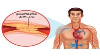 இந்த அறிகுறிகள் இருந்தால் உங்கள் தமனி சுவர்களில் அதிகளவு கொழுப்பு படிந்துள்ளதாம்... இது உயிருக்கே ஆபத்தாம்! 