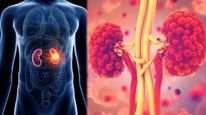 World Kidney Day 2023: யாருக்கெல்லாம் சிறுநீரக புற்றுநோய் வர வாய்ப்புள்ளது தெரியுமா? 