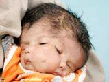 A Baby With Two Faces Born In India