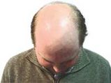 Pollution Leads To Baldness