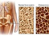 Youth Prone To Osteoporosis