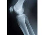 Interlocking Technology Better Than Plaster In Bone Fractures