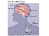 Deep Brain Stimulation