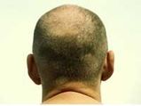 Baldness That Became More Than A Cut