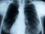 Mesothelioma: The Most Dangerous Cancer To Grip Your Breath!