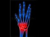 Vitamin-D Deficiency Leads To Rheumatoid Arthritis