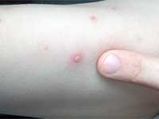 Smallpox Causes, Symptoms and Home remedies
