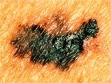Skin Cancer Caused By A Protein