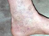 Painful Varicose Veins Treatment